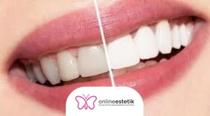 Estetik Diş Hekimliği 